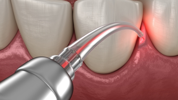 Illustrated laser treating the gums
