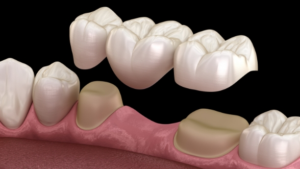 Illustrated dental bridge fitted over two natural teeth