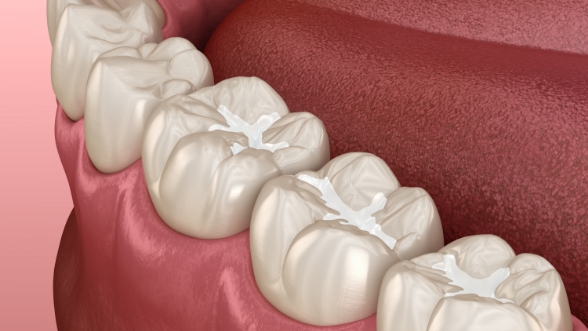 Illustrated row of teeth with white fillings