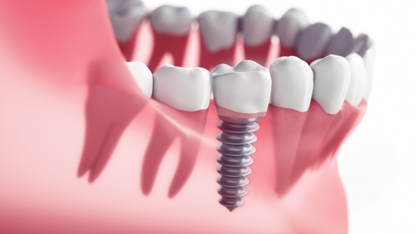 Illustrated row of teeth with one replaced by a dental implant