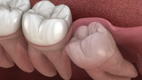 Illustrated wisdom tooth pushing against another tooth