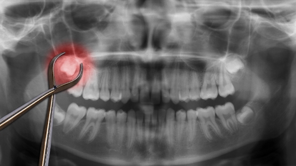 Dental forceps in front of x ray of teeth with impacted wisdom tooth highlighted red
